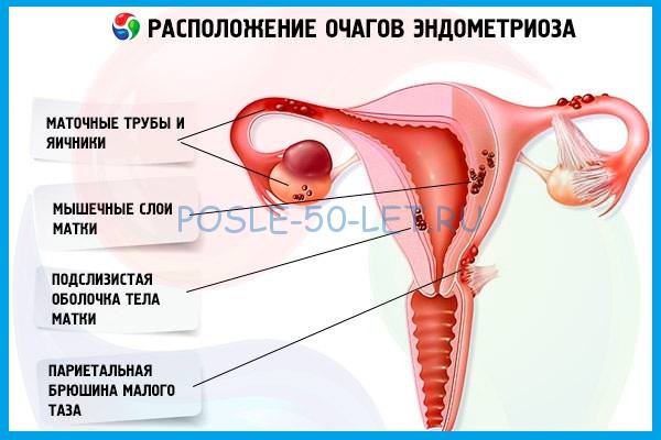 Что такое эндометриоз: симптомы, лечение