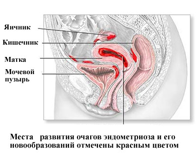 Что такое эндометриоз: симптомы, лечение