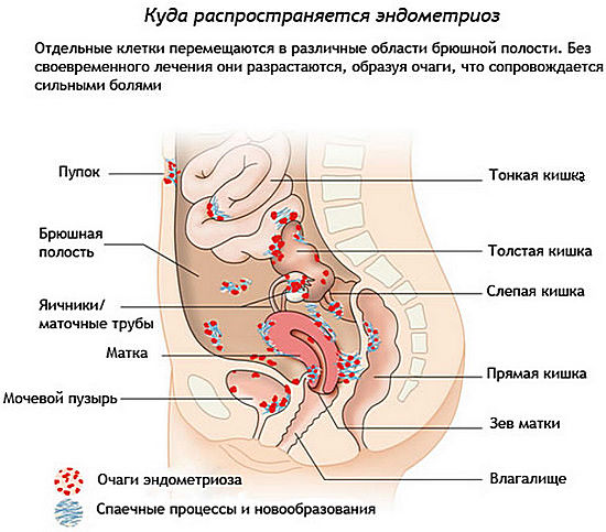 Что такое эндометриоз: симптомы, лечение