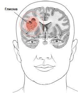 Что такое глиома головного мозга, каков прогноз жизни?
