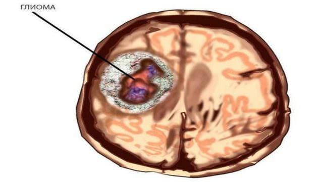 Глиома форум. Неоперабельная опухоль головного мозга. Опухоль головного мозга неоперабельная фото. Глиальная опухоль головного мозга.