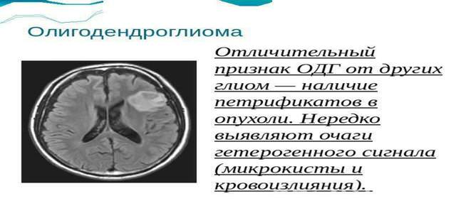 Что такое глиома головного мозга, каков прогноз жизни?