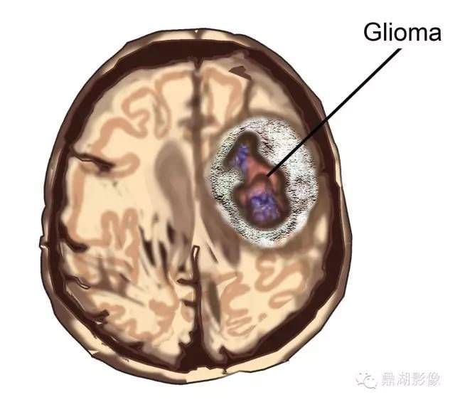 Что такое глиома головного мозга, каков прогноз жизни?