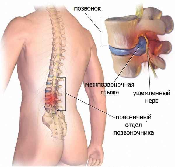 Что такое миелография позвоночника, методы проведения процедуры