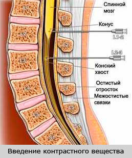 Что такое миелография позвоночника, методы проведения процедуры