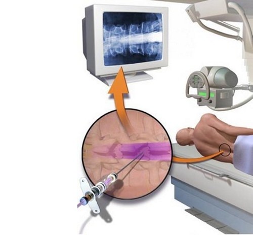 Что такое миелография позвоночника, методы проведения процедуры