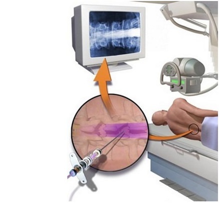 Что такое миелография позвоночника, методы проведения процедуры