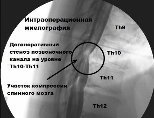 Что такое миелография позвоночника, методы проведения процедуры