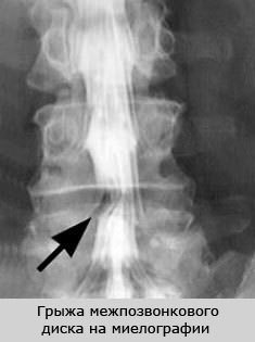 Что такое миелография позвоночника, методы проведения процедуры