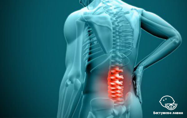 Что такое радикулит: симптомы и лечение в домашних условиях