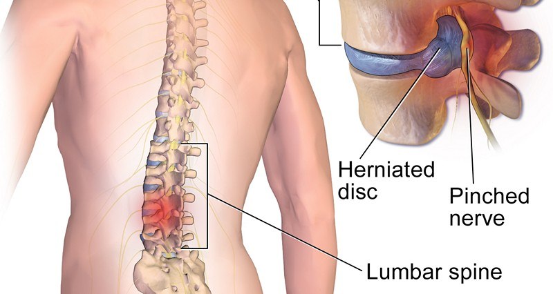 Что такое радикулит: симптомы и лечение в домашних условиях