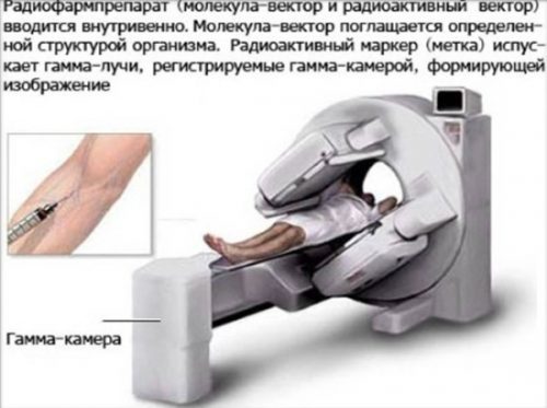 Что такое сцинтиграфия костей и органов: особенности метода, причины назначения, ограничения к проведению, ход процедуры