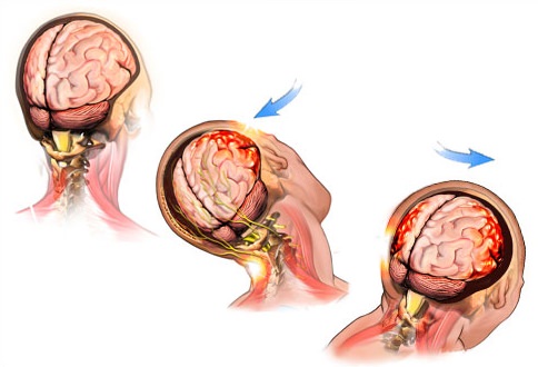 Что такое сотрясение головного мозга — симптомы и лечение, последствия
