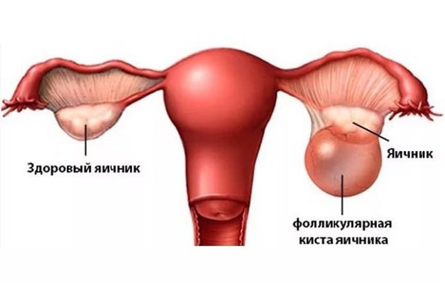 Что значит результат 26,43 по онкомаркеру са 125?