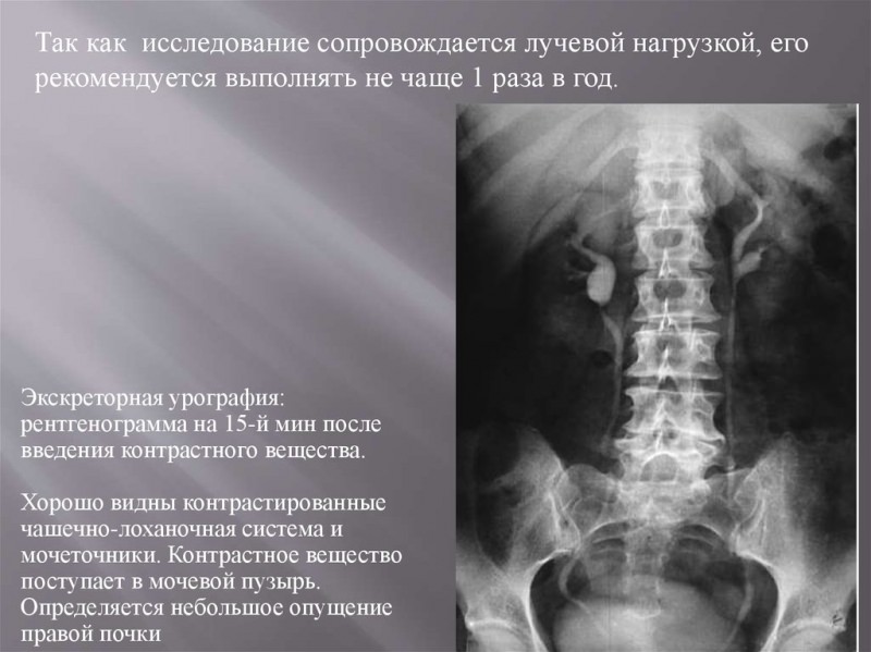 Цистография у детей: 6 показаний и 7 противопоказаний к проведению