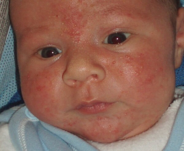 Цветение новорожденных: причины акне, как отличить от аллергии, лечение