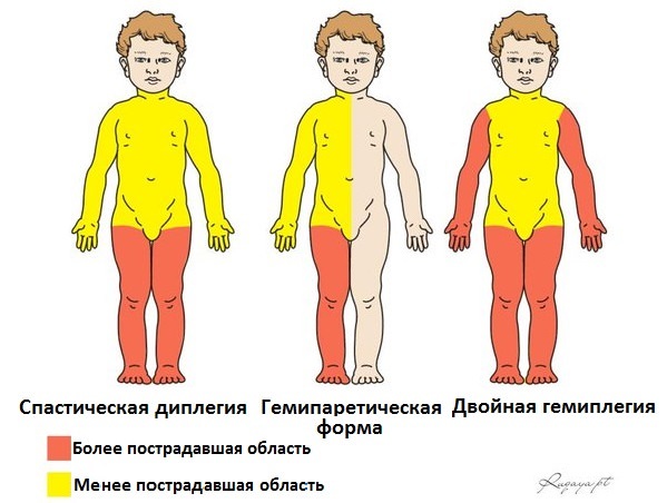 Дцп или детский церебральный паралич, что это за болезнь, лечение у новорожденных детей