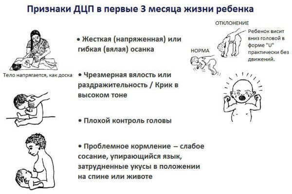 Дцп или детский церебральный паралич, что это за болезнь, лечение у новорожденных детей