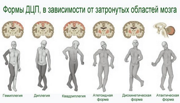 Дцп причины возникновения детского церебрального паралича, симптомы и формы