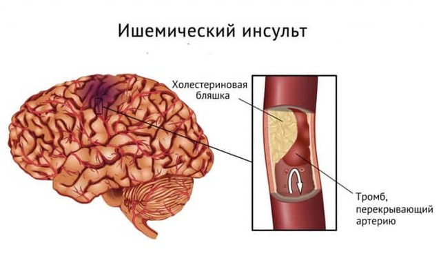 Дцп причины возникновения при беременности, диагностика