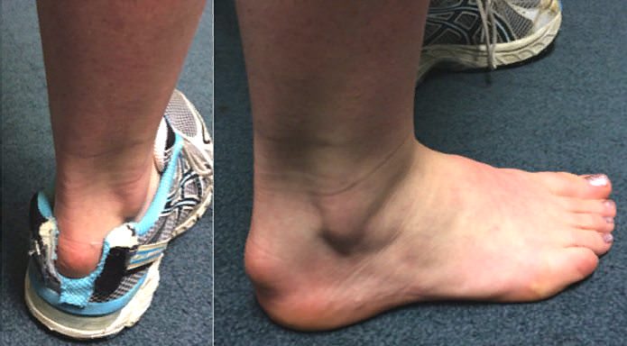 Деформация хаглунда &mdash; причины, симптомы, лечение