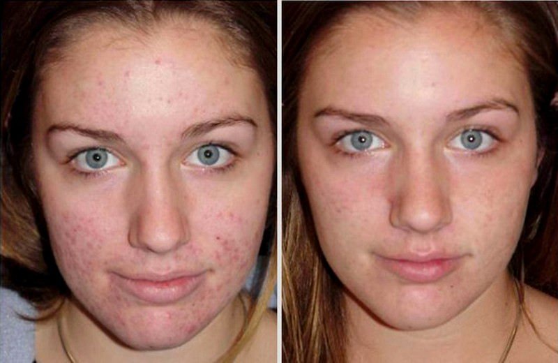 Дегтярное мыло: применение от прыщей, польза и вред для кожи