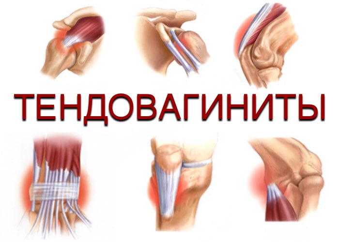 Деление климактерического синдрома по степеням тяжести: причины, симптомы и лечение