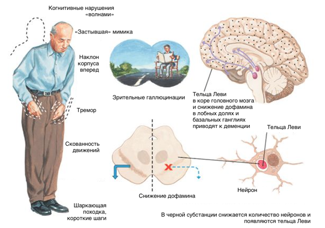 Деменция с тельцами леви височно-лобная, причины и симптомы