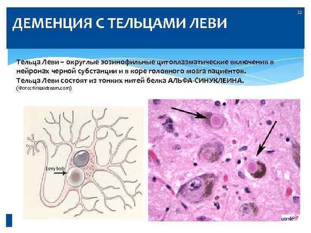 Деменция с тельцами леви височно-лобная, причины и симптомы