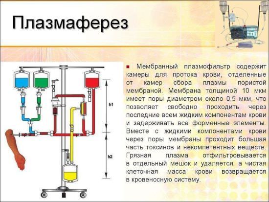 Демиелинизирующая полинейропатия, хроническая воспалительная