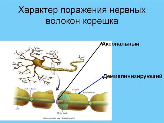 Демиелинизирующая полинейропатия, хроническая воспалительная