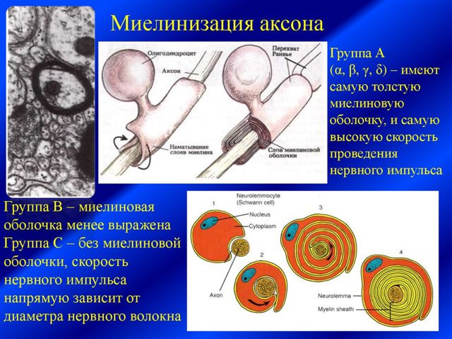 Демиелинизирующее заболевание головного мозга – что это такое, лечение