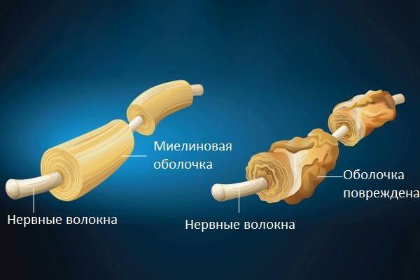 Демиелинизирующее заболевание головного мозга – что это такое, лечение