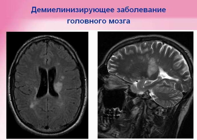 Демиелинизирующее заболевание головного мозга – что это такое, лечение