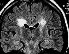 Демиелинизирующее заболевание головного мозга – что это такое, лечение