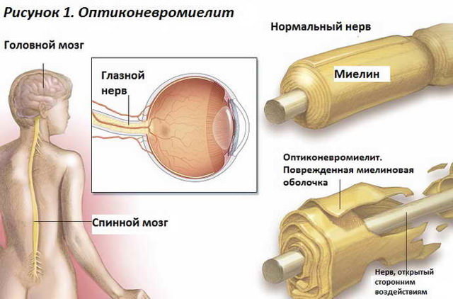 Демиелинизирующее заболевание головного мозга – что это такое, лечение