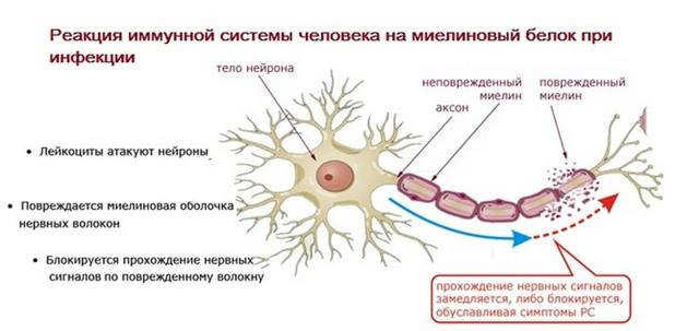 Демиелинизирующее заболевание головного мозга – что это такое, лечение