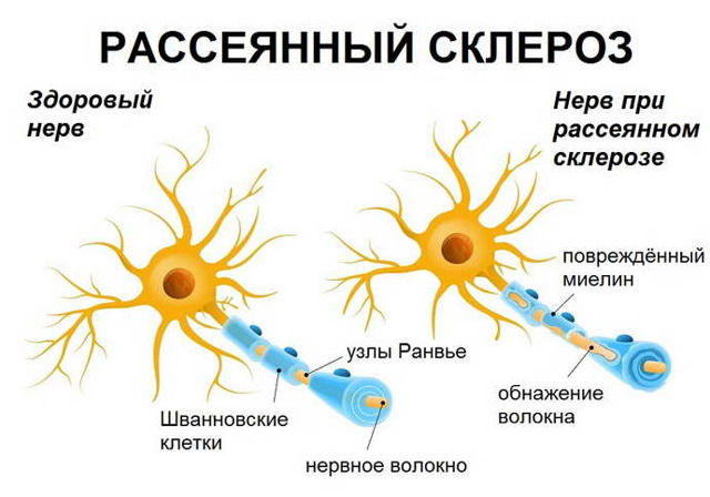 Демиелинизирующее заболевание головного мозга – что это такое, лечение