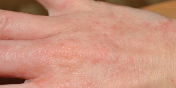 Дерматит – народная медицина/ народные средства от кожного дерматита