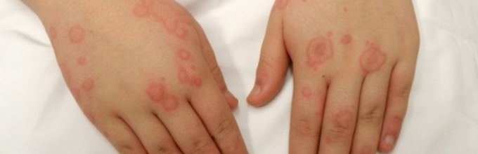 Дерматит – народная медицина/ народные средства от кожного дерматита