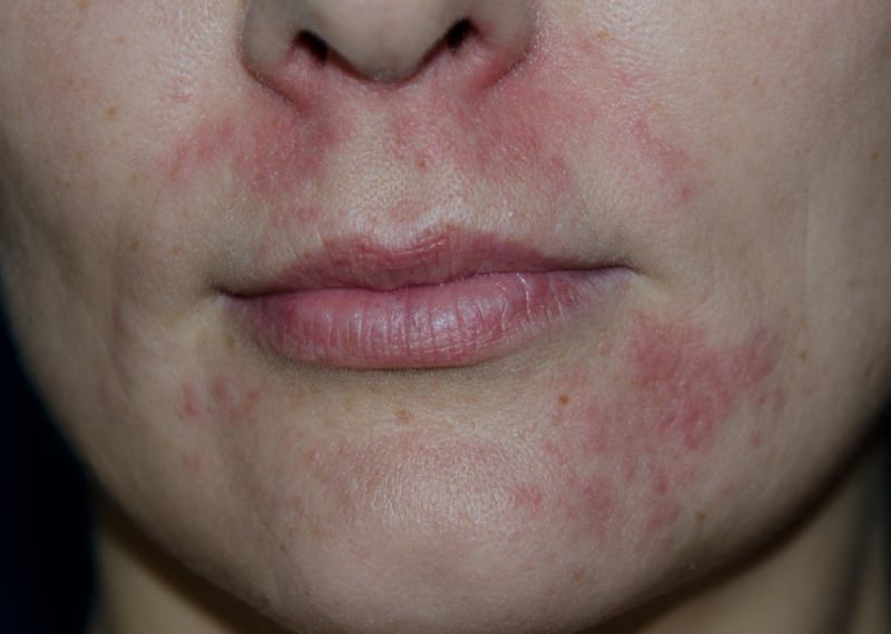 Дерматит – народная медицина/ народные средства от кожного дерматита