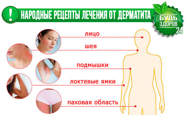 Дерматит – народная медицина/ народные средства от кожного дерматита