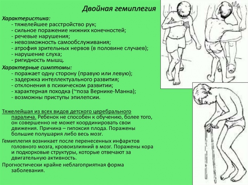 Детский церебральный паралич: 7 ранних признаков, 4 линии терапии