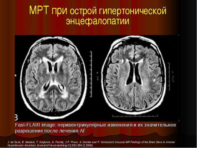 Диабетическая энцефалопатия с выраженными нарушениями