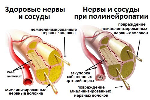 Диабетическая нейропатия, ее симптомы и лечение