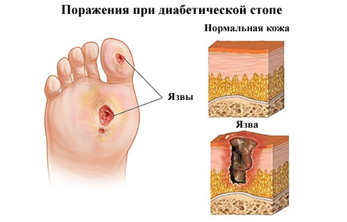 Диабетическая нейропатия, ее симптомы и лечение