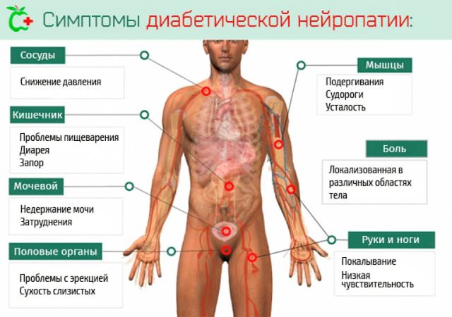 Диабетическая полинейропатия нижних конечностей: симптомы и лечение