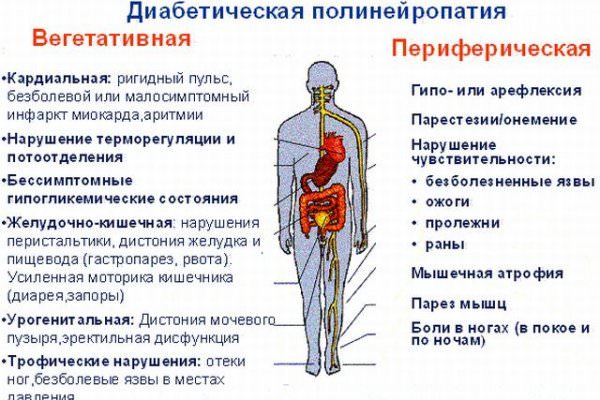 Диабетическая полинейропатия нижних конечностей: симптомы и лечение