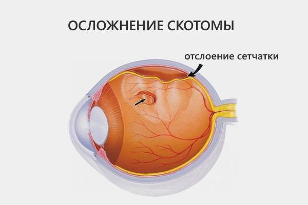 Диагностика и лечение офтальмологической и мерцательной скотомы