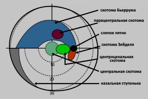 Диагностика и лечение офтальмологической и мерцательной скотомы